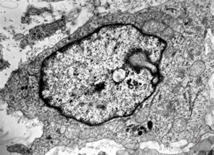 M,15y. | eosinophilic granuloma - Langerhans cell